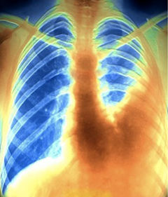 pulmoner emboli nedir reitix com pulmoner emboli nedir reitix com